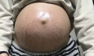 出産前日の妊娠線