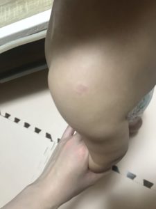 いちご状血管腫